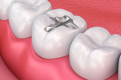 Steven R. Feigelson, DDS | Bridges   Dentures, Teeth Whitening and Gum Treatment