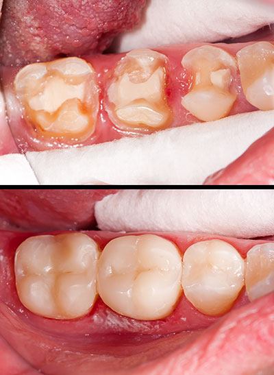 Steven R. Feigelson, DDS | Dental Implant Restoration, Same Day Crowns and Gum Treatment