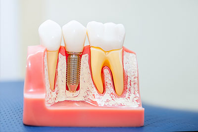 Steven R. Feigelson, DDS | Extractions, Same Day Crowns and Preventative Program